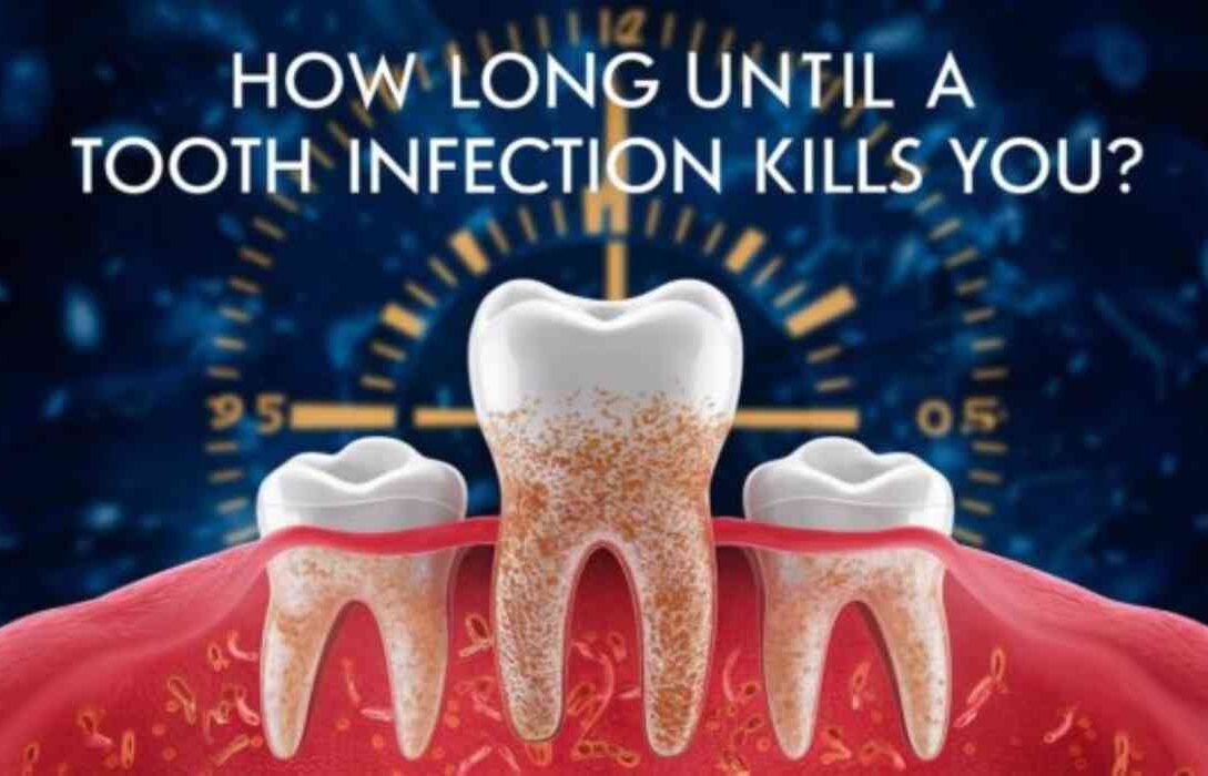 How Long Until A tooth Infection Kills You